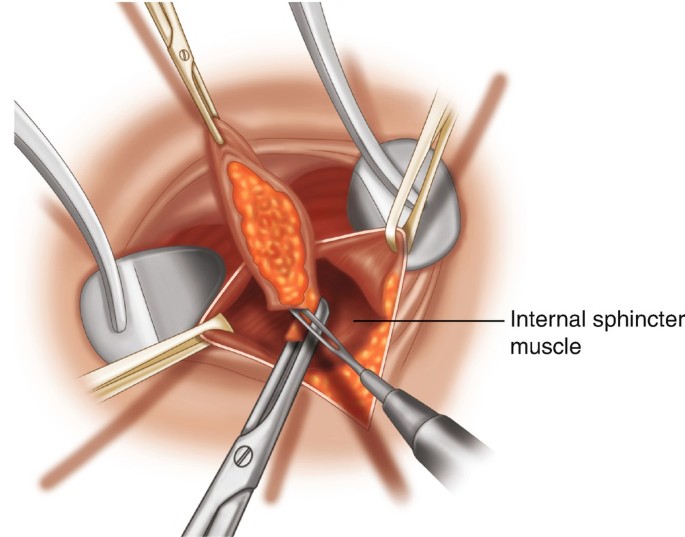 Hemorrhoidectomy | SpringerLink