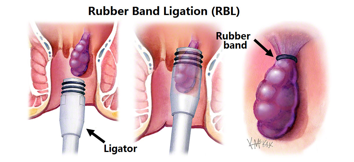 Rubber Band Ligation Explained