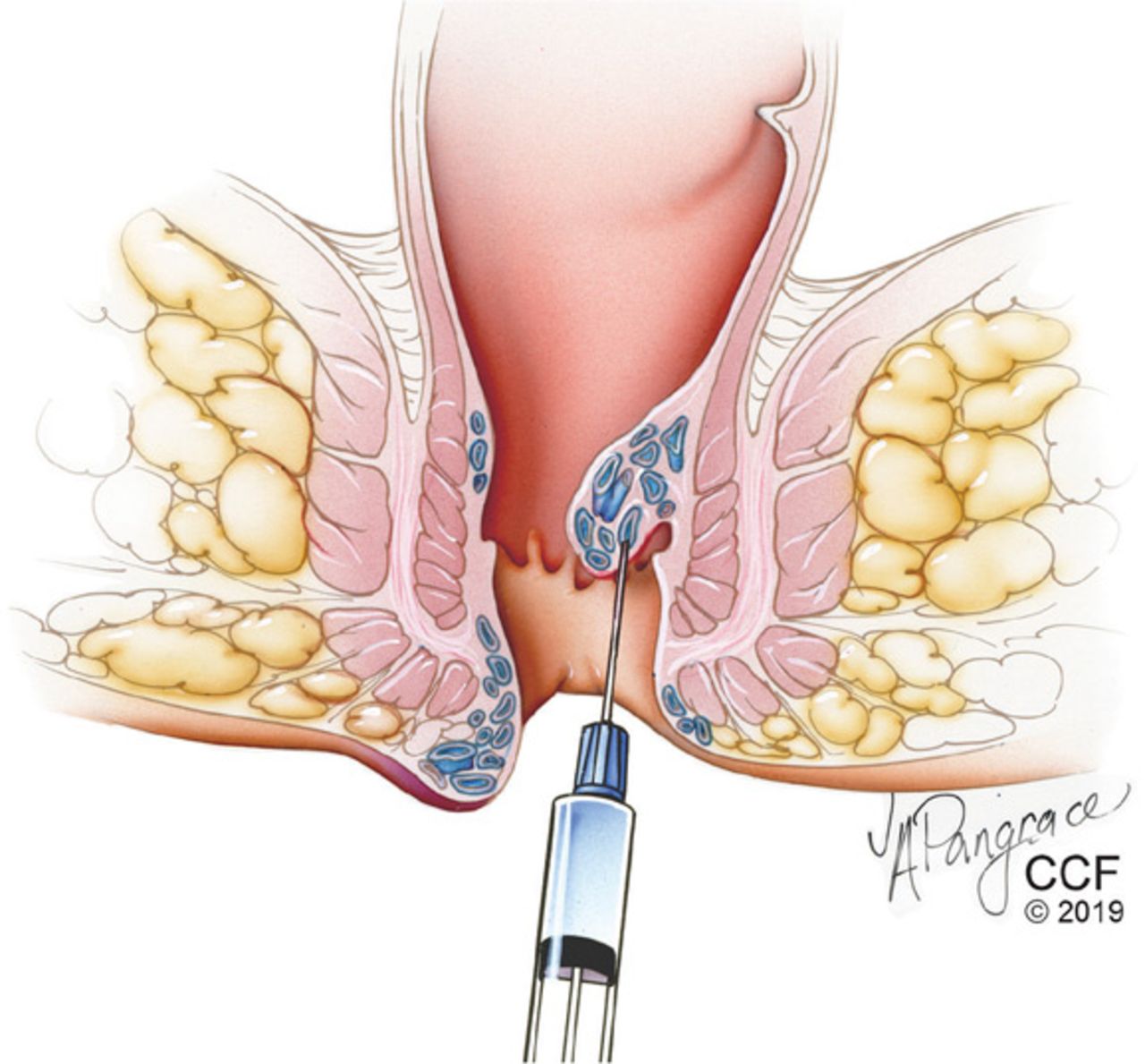 Hemorrhoids: A range of treatments | Cleveland Clinic Journal of Medicine