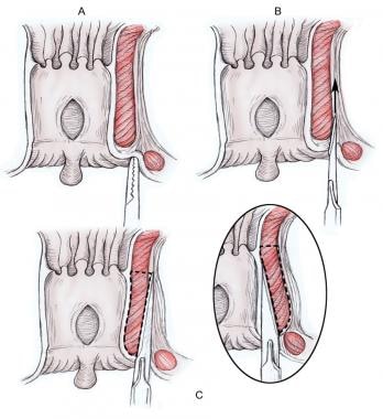 Surgery for Anal Fissure Technique: Lateral Internal Sphincterotomy,  Fissurectomy, Chemical Sphincterotomy