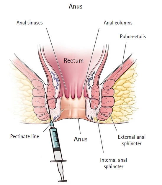 Botulinum injection technique to reduce spasms in refractory anal fissures  and after anal fistula or hemorrhoid surgery