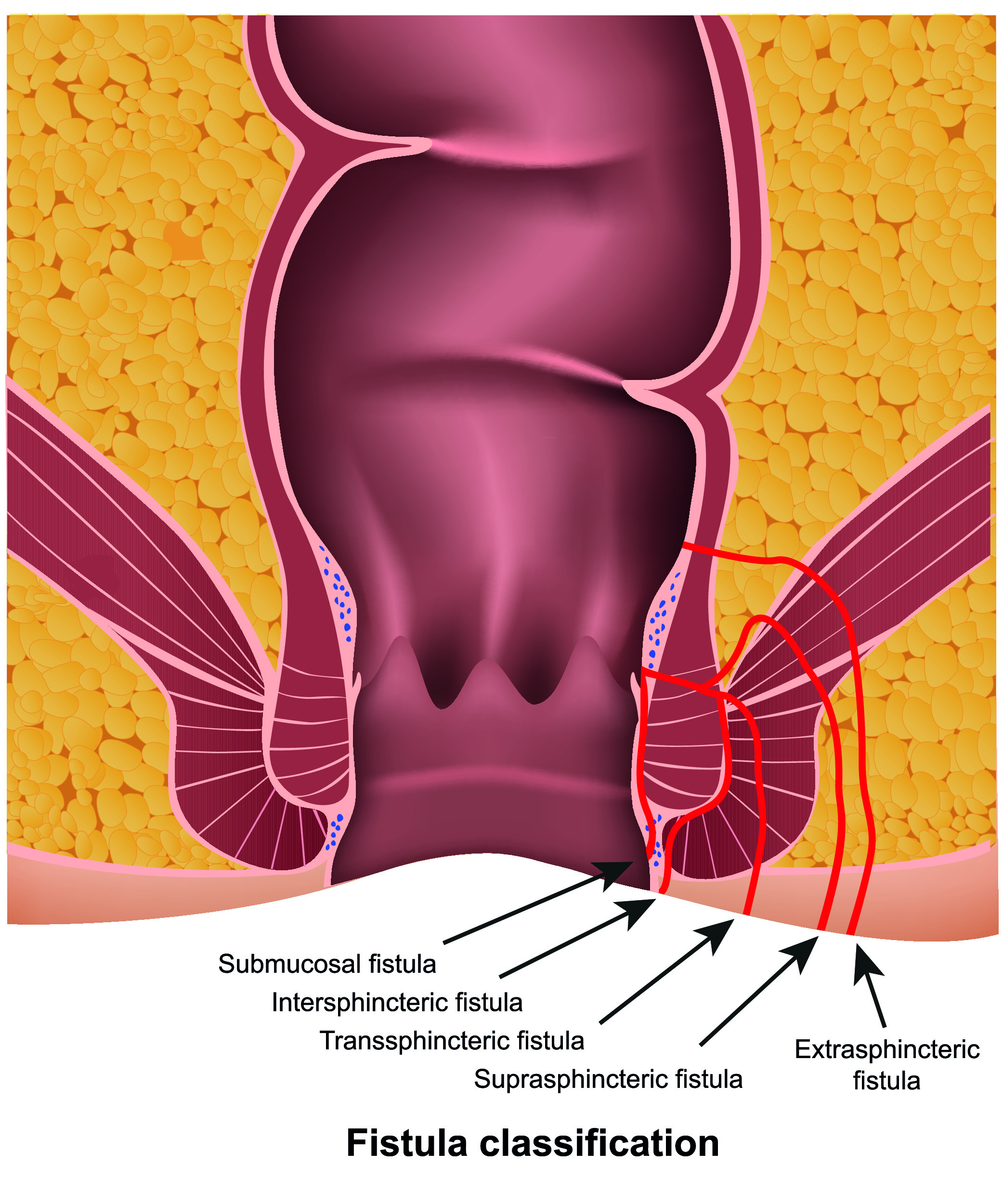 Fistulectomy - neo