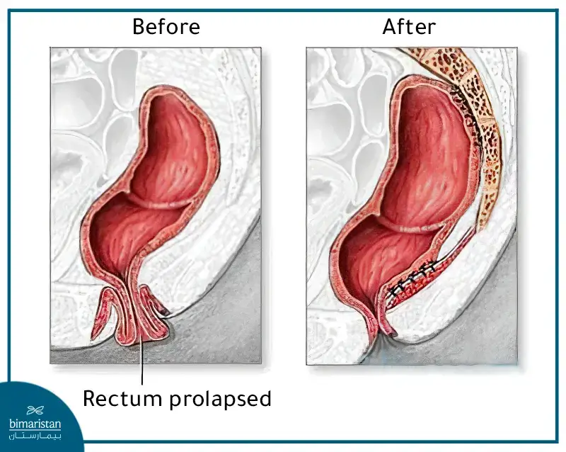 Minimally invasive Rectal Prolapse Surgery in Turkey