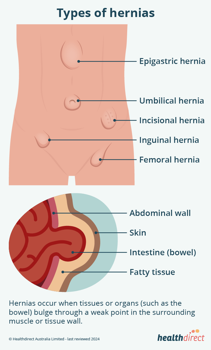 Inguinal hernia | healthdirect