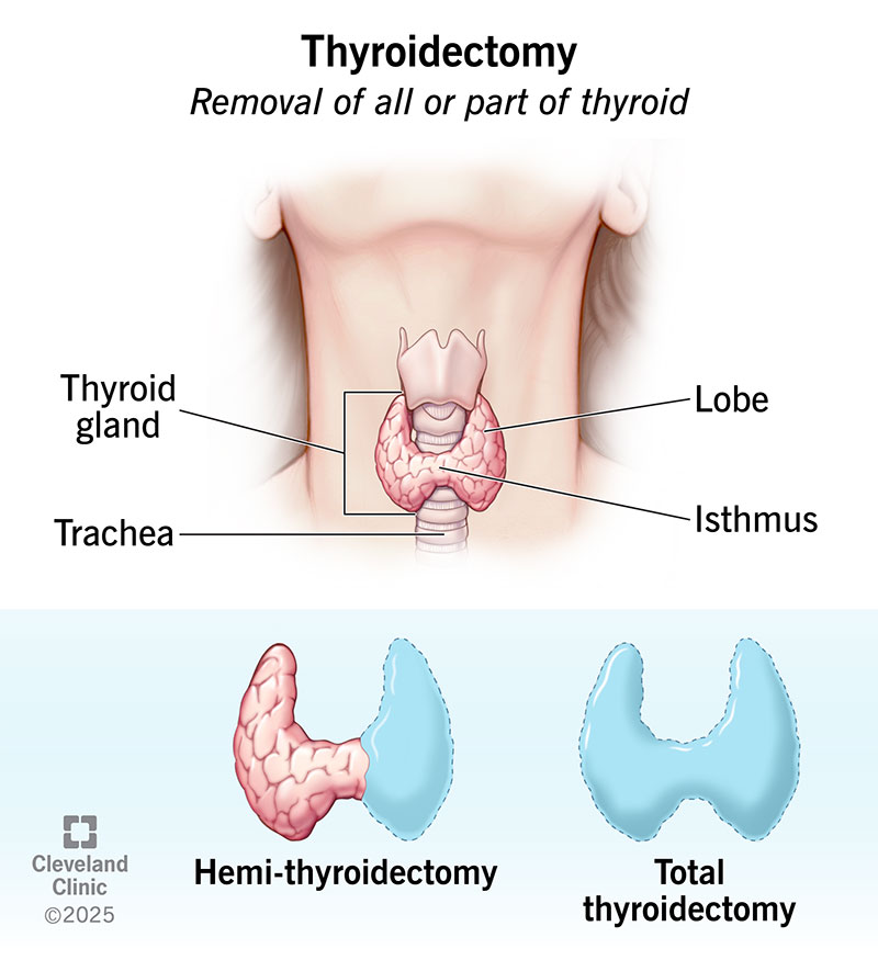 Thyroidectomy (Thyroid Surgery): What It Is & Recovery