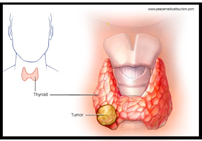 Thyroid Cancer Treatment cost in India - Top Thyroid Cancer...