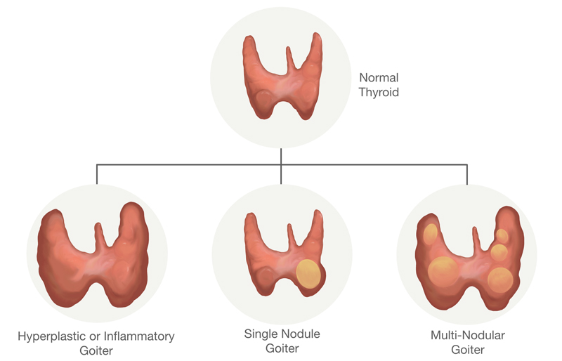 Goiter - Larian, MD