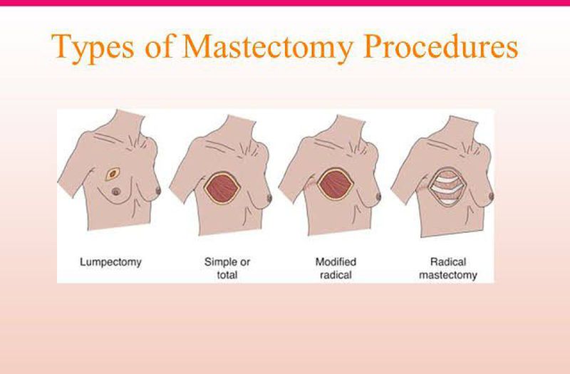 Mastectomy - MEDizzy