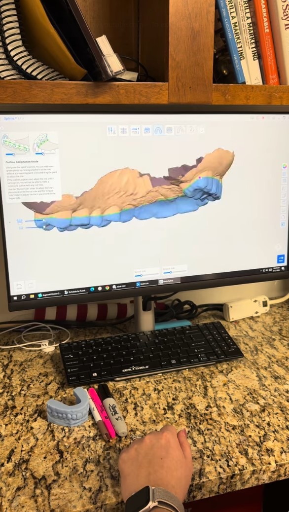 Computer screen shows 3D dental model with jaw and teeth; keyboard, markers, and model on desk.