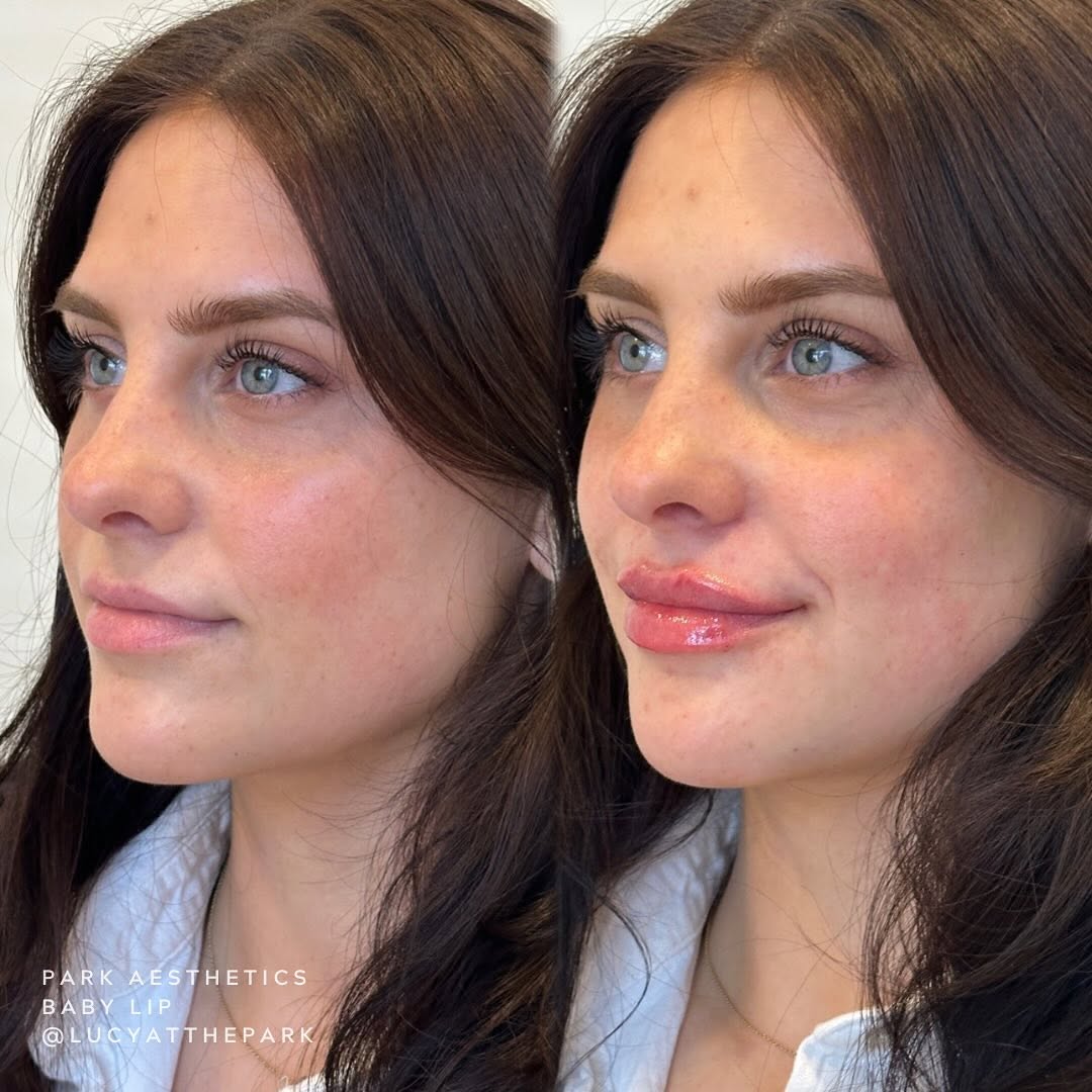 Women's Face After Dermal Fillers Injectable Treatments