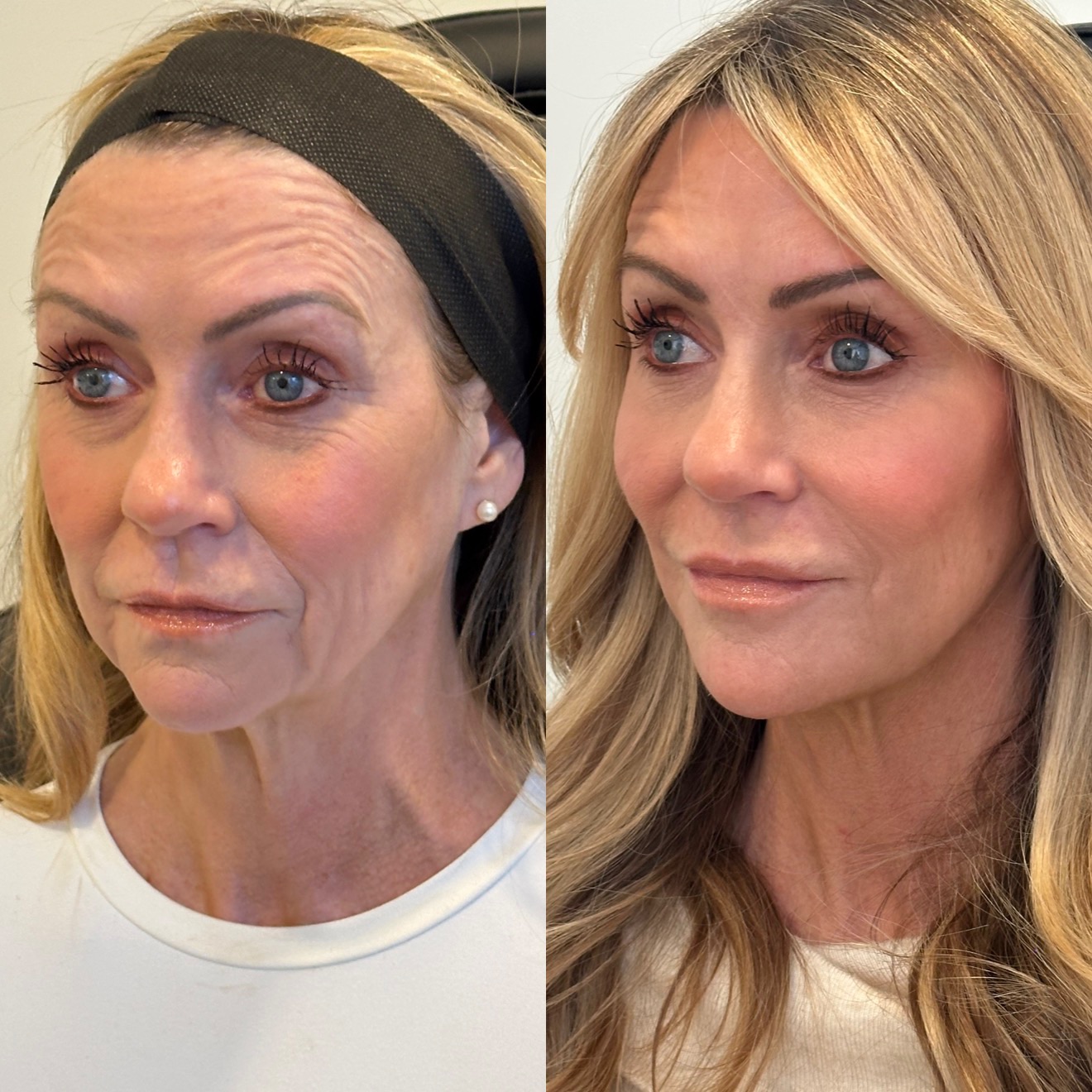 A Before And After Photo Of A Woman Who Got Botox And Fillers
