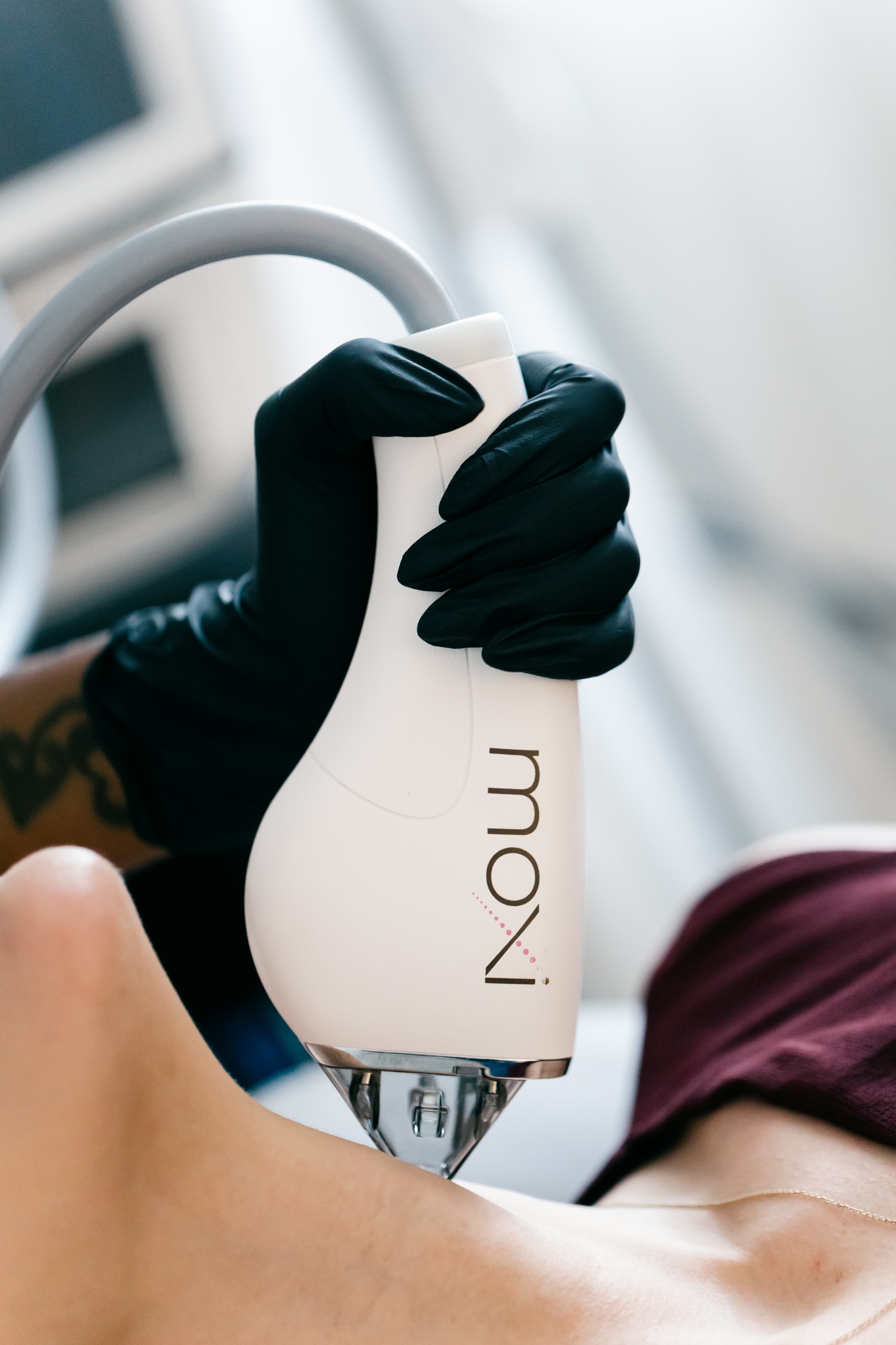 Girls Face After Getting Dermal Filler