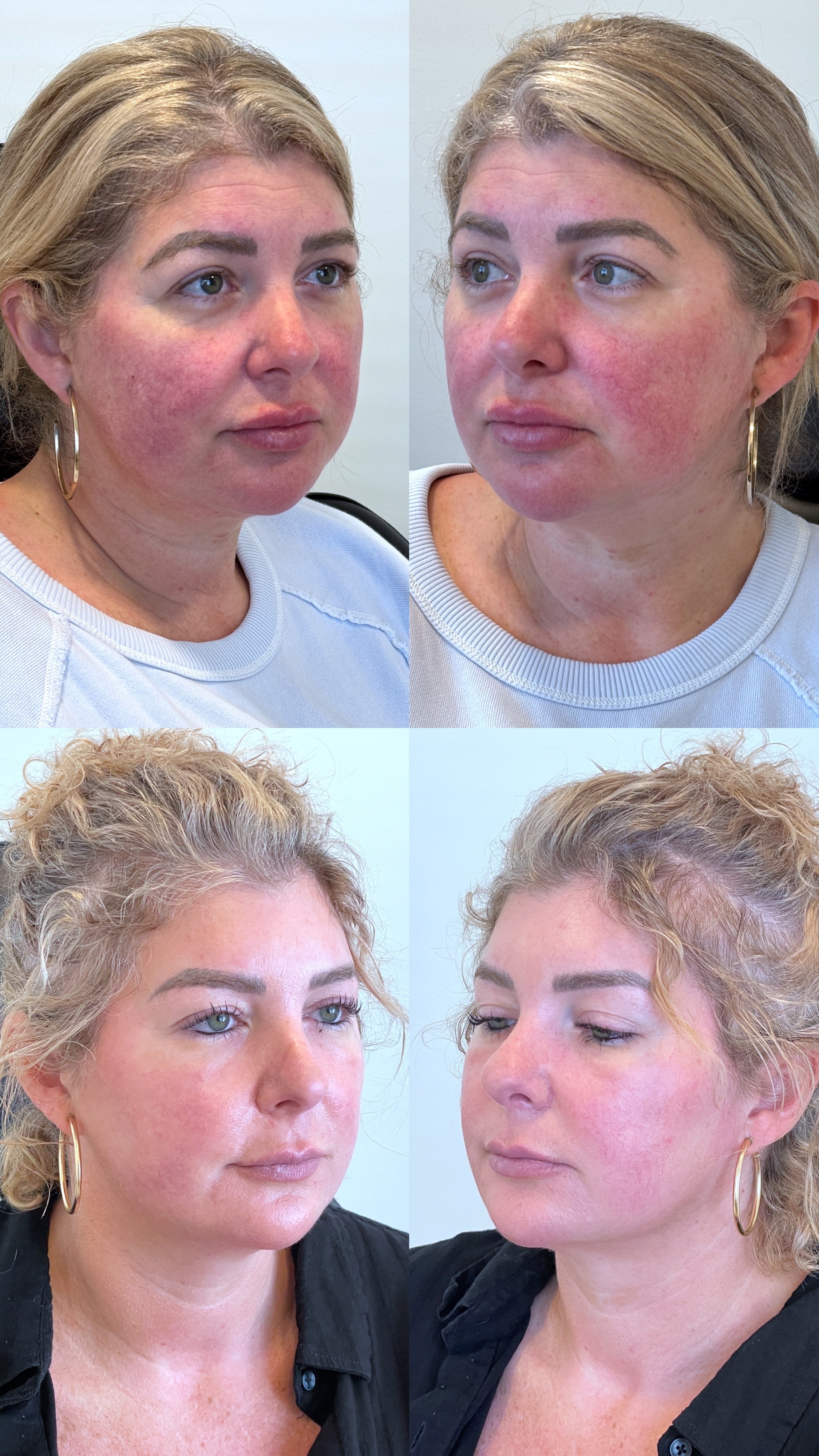 Dermal Fillers Tretment Before & After