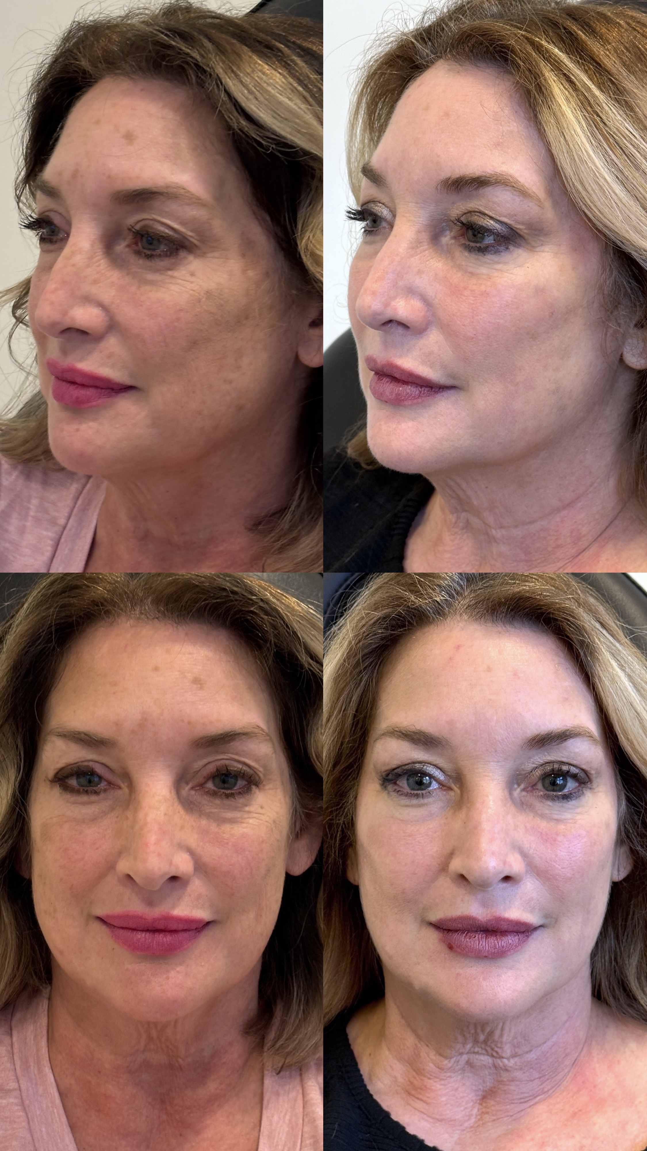 Before & After Personalized Dermal Treatments