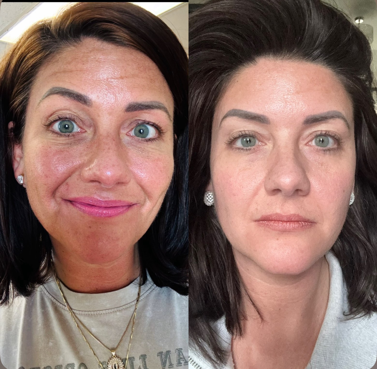 Before & After Personalized Dermal Treatments