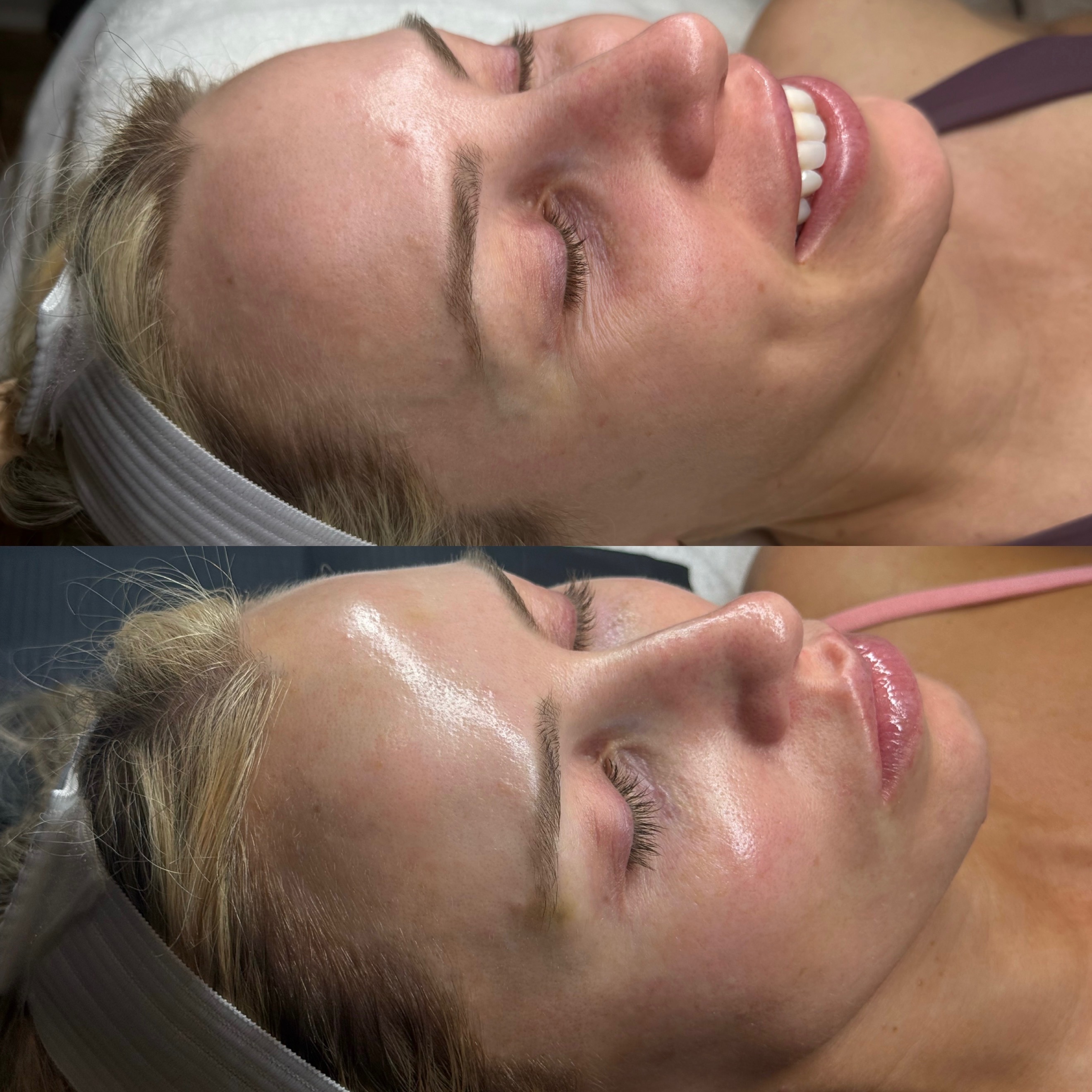 Women's Face After Dermal Fillers Injectable Treatments