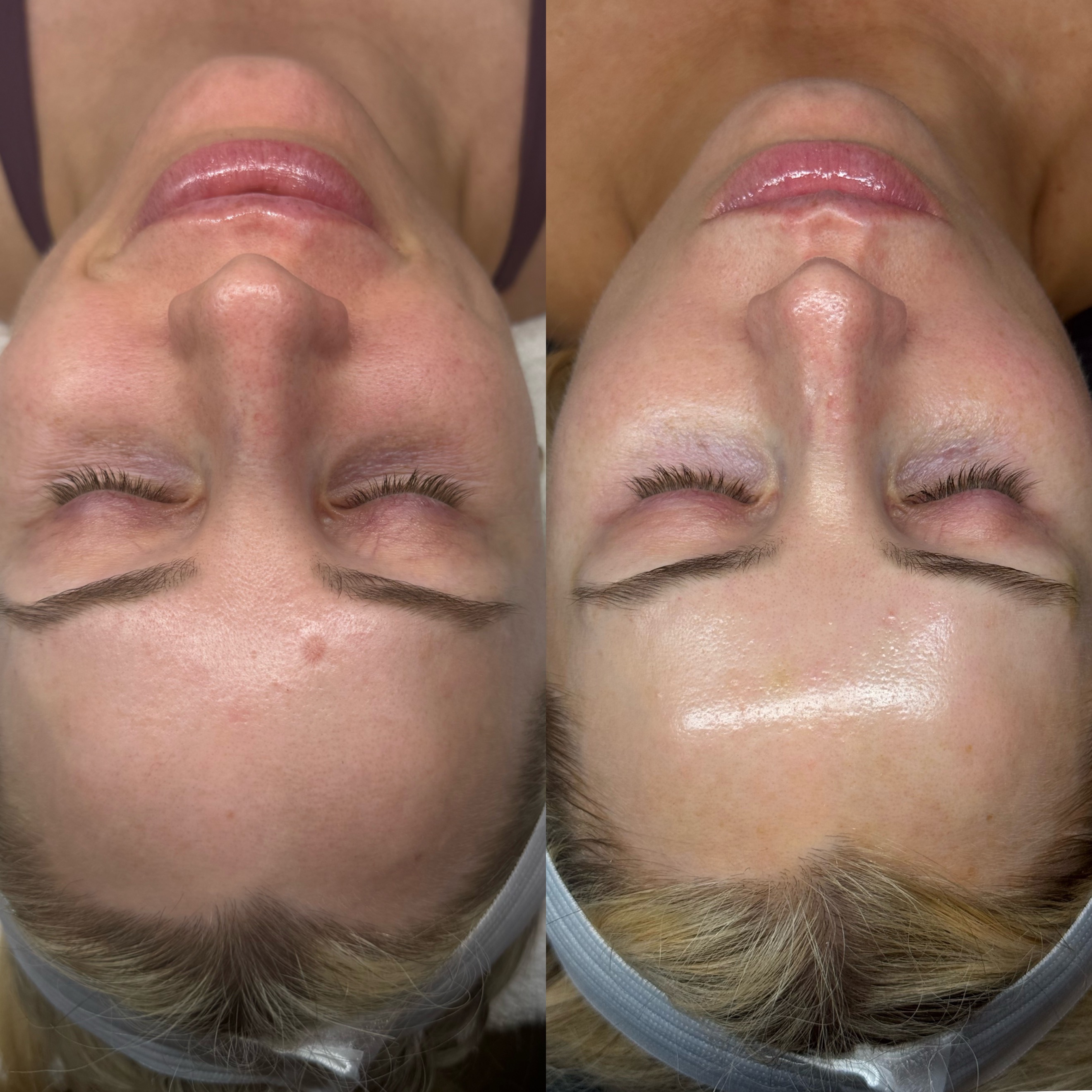 Before & After Personalized Dermal Treatments