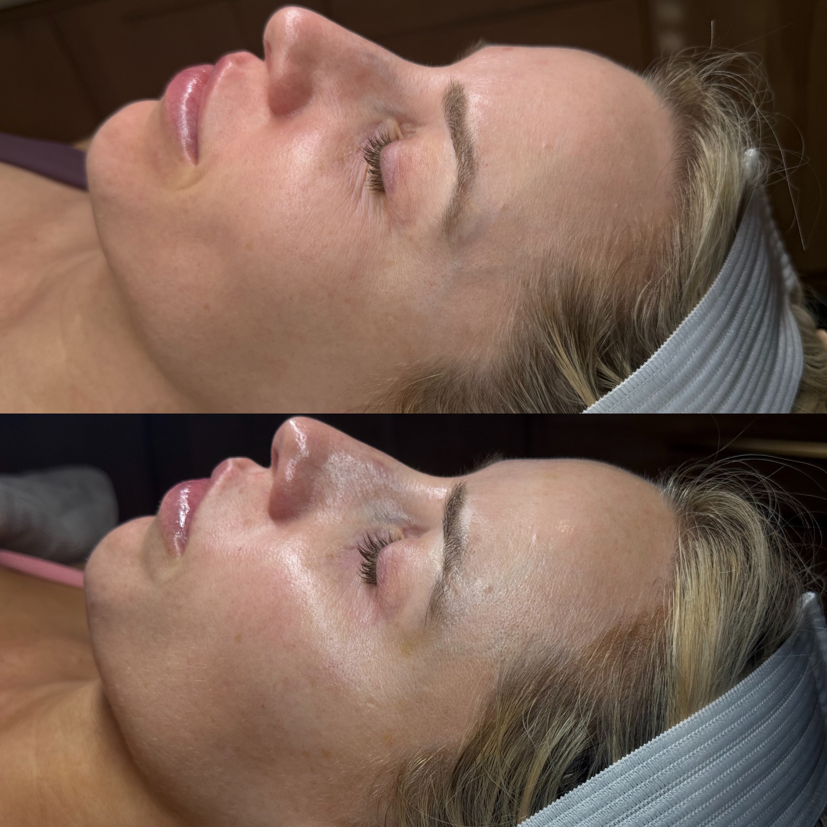 Girls Face After Getting Dermal Filler