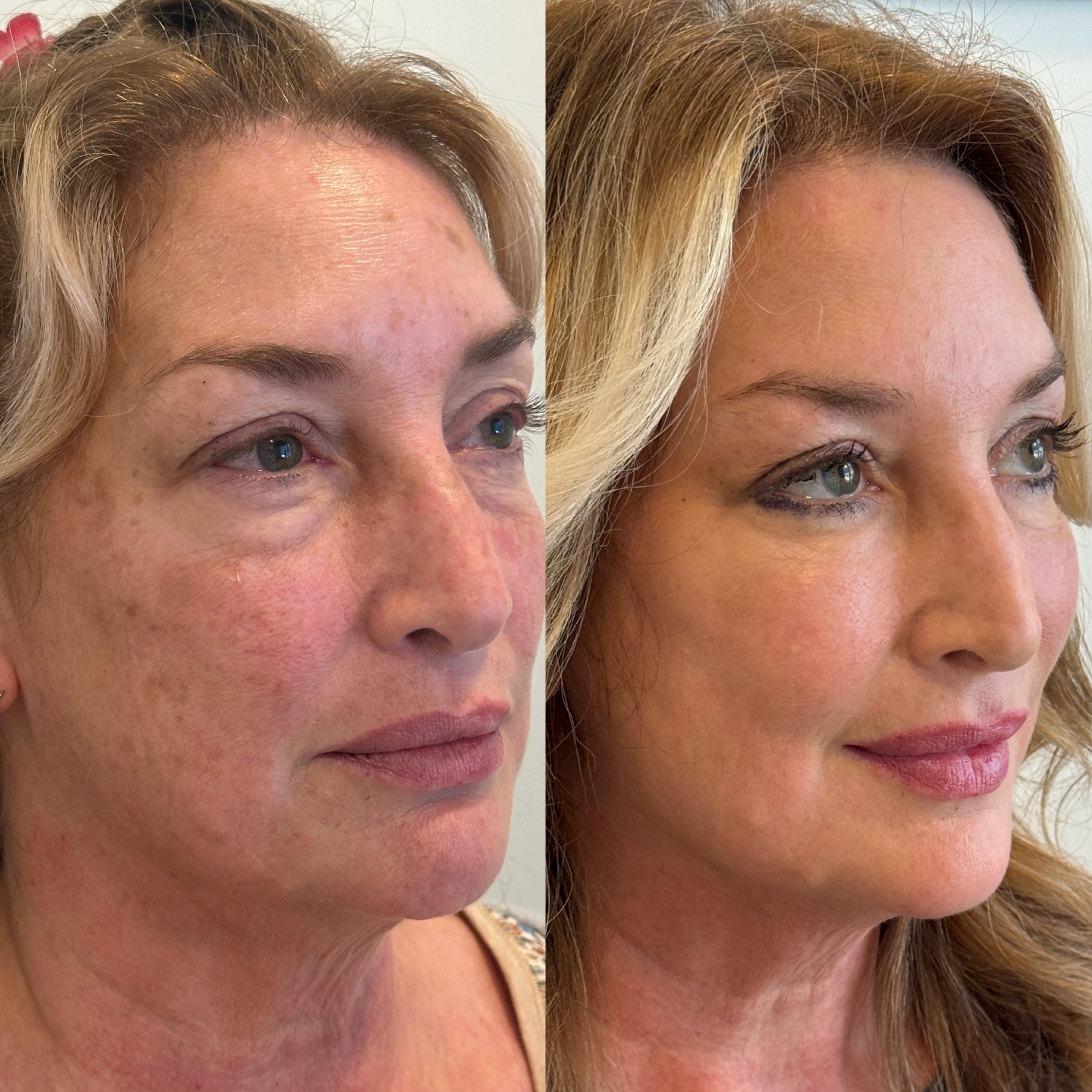 Girls Face After Getting Dermal Filler