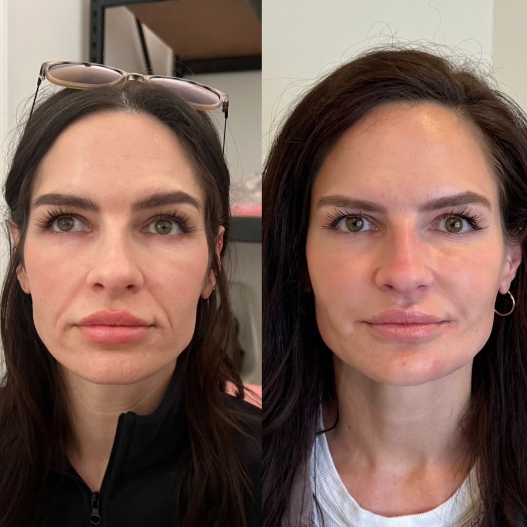 Blueprint patient before and after — Park Aesthetics