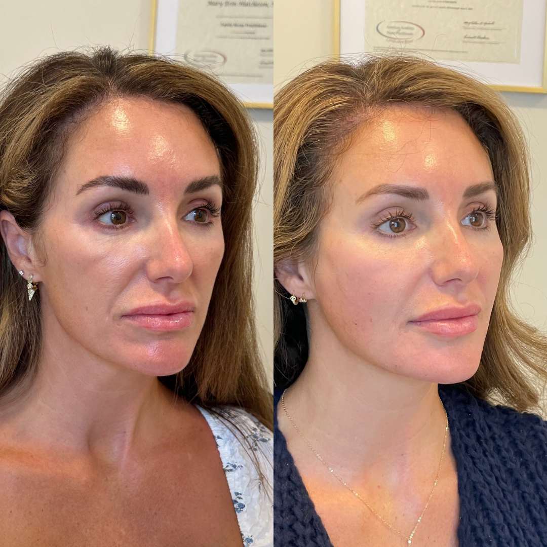 Blueprint patient before and after — Park Aesthetics