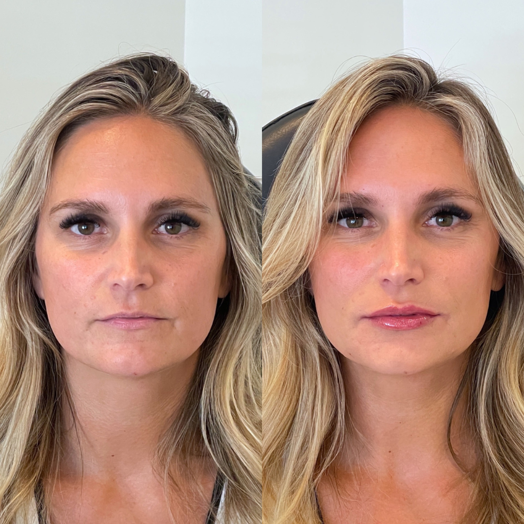 Blueprint patient before and after — Park Aesthetics
