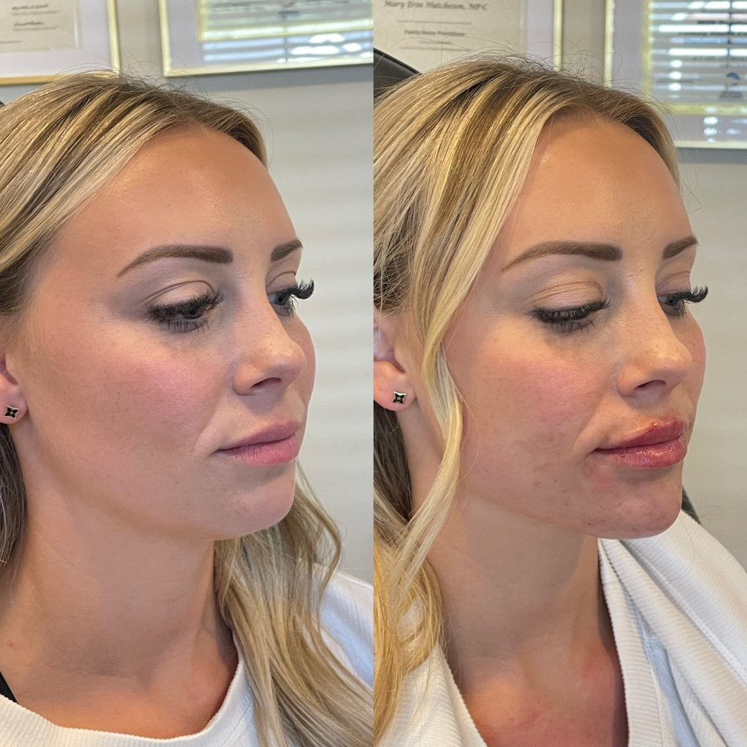 Blueprint patient before and after — Park Aesthetics