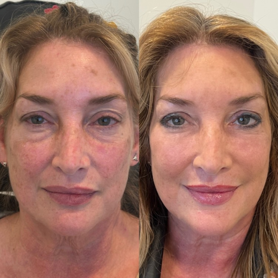 Blueprint patient before and after — Park Aesthetics