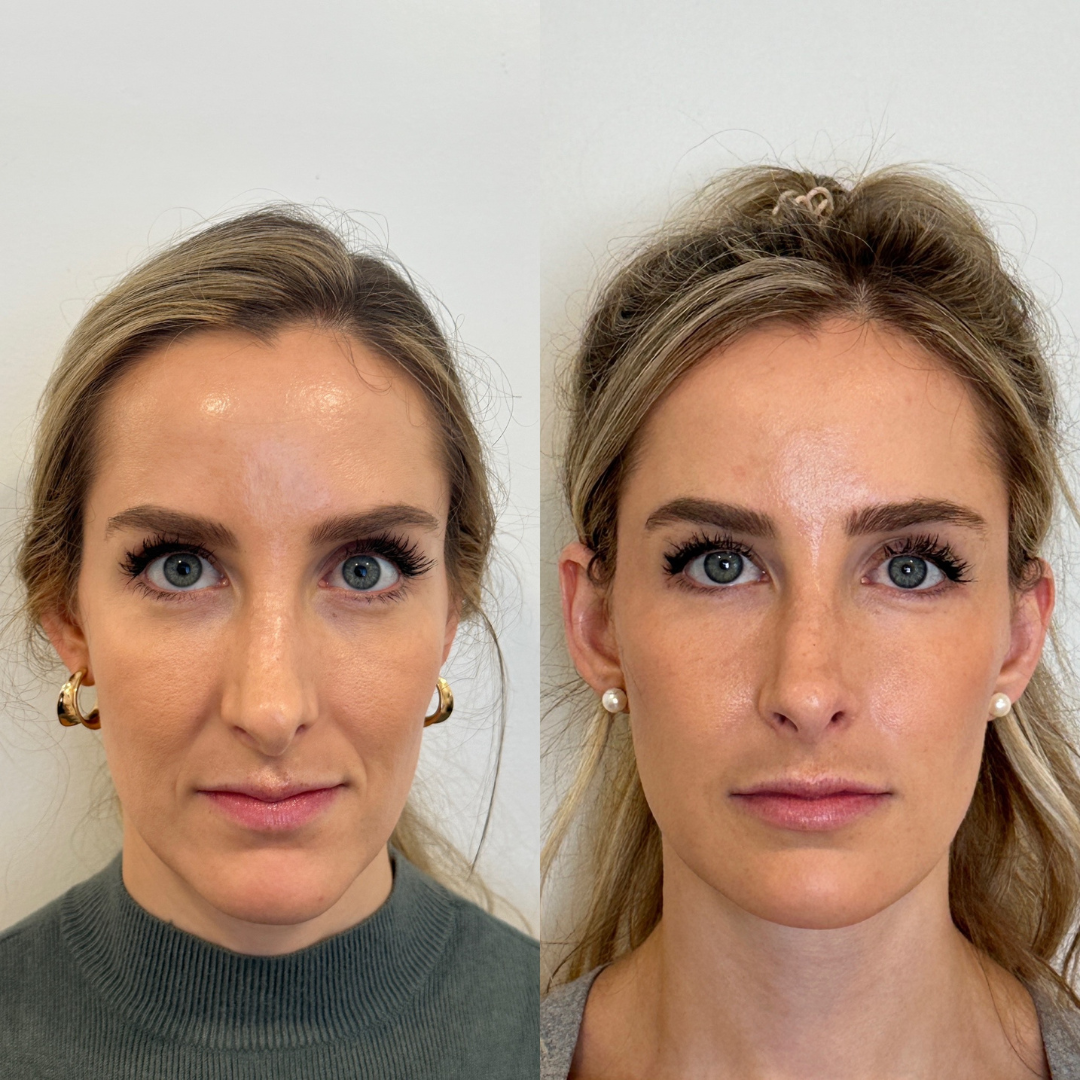 Blueprint patient before and after — Park Aesthetics