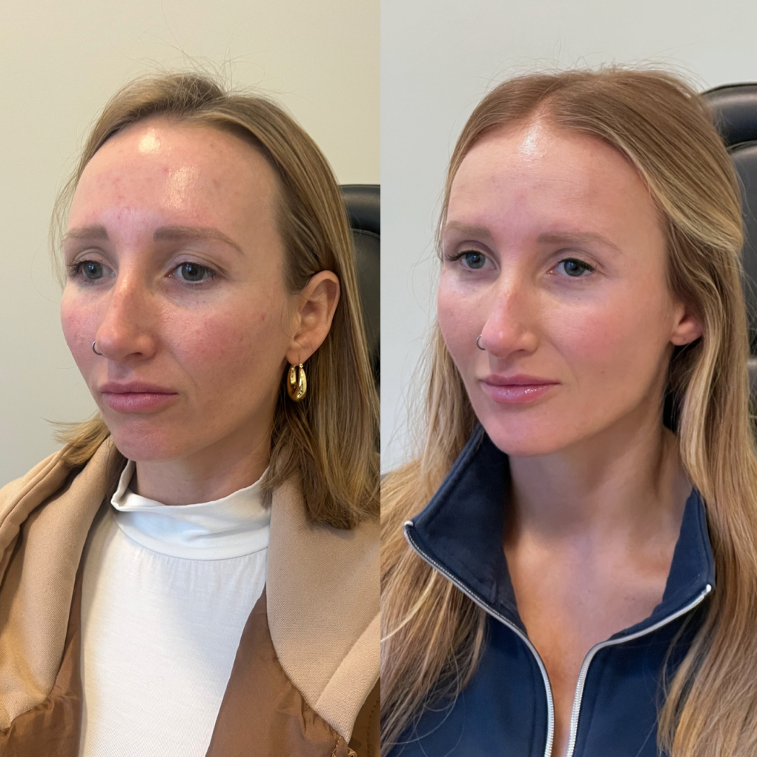 Blueprint patient before and after — Park Aesthetics