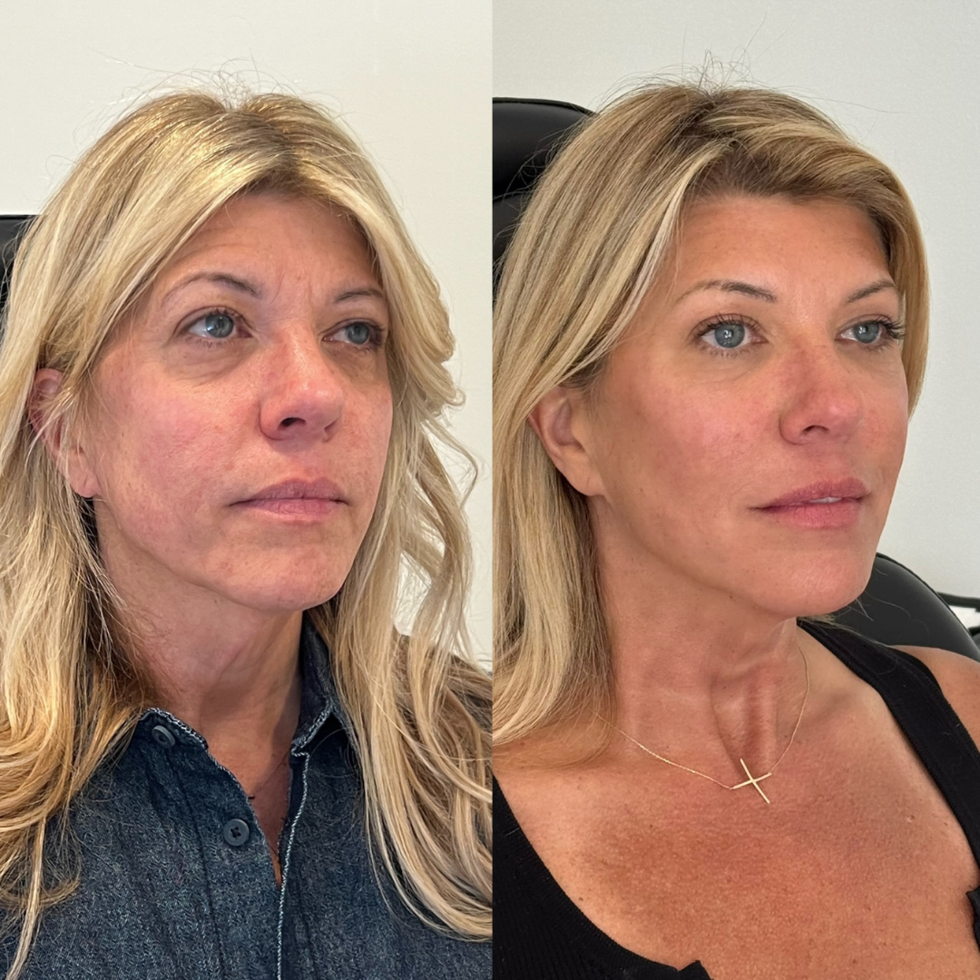 Blueprint patient before and after — Park Aesthetics