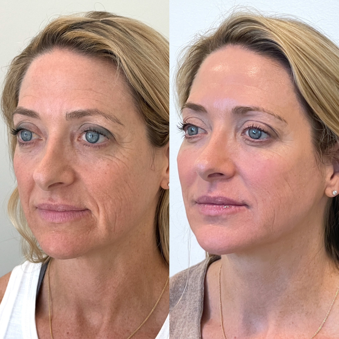 Blueprint patient before and after — Park Aesthetics