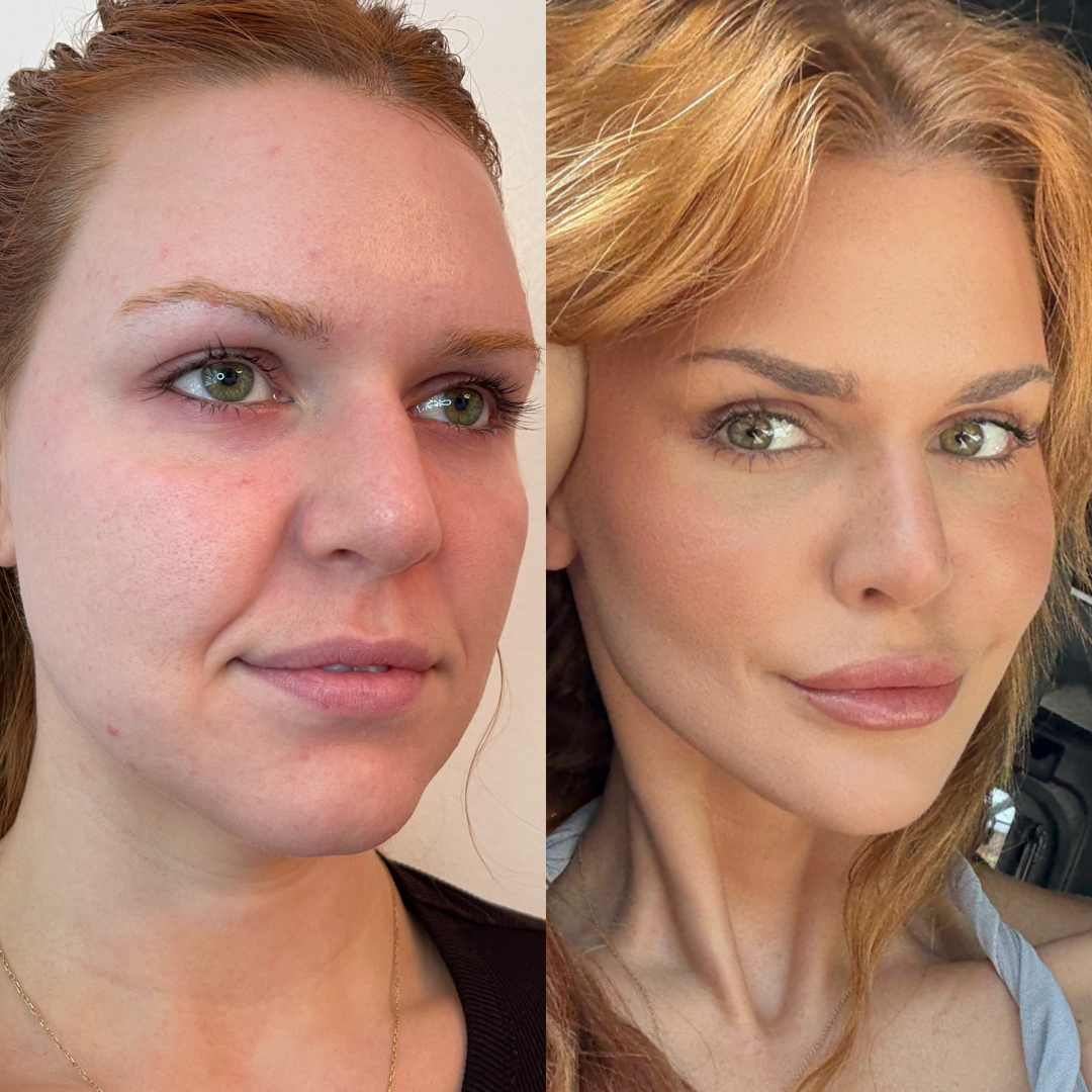 Blueprint patient before and after — Park Aesthetics