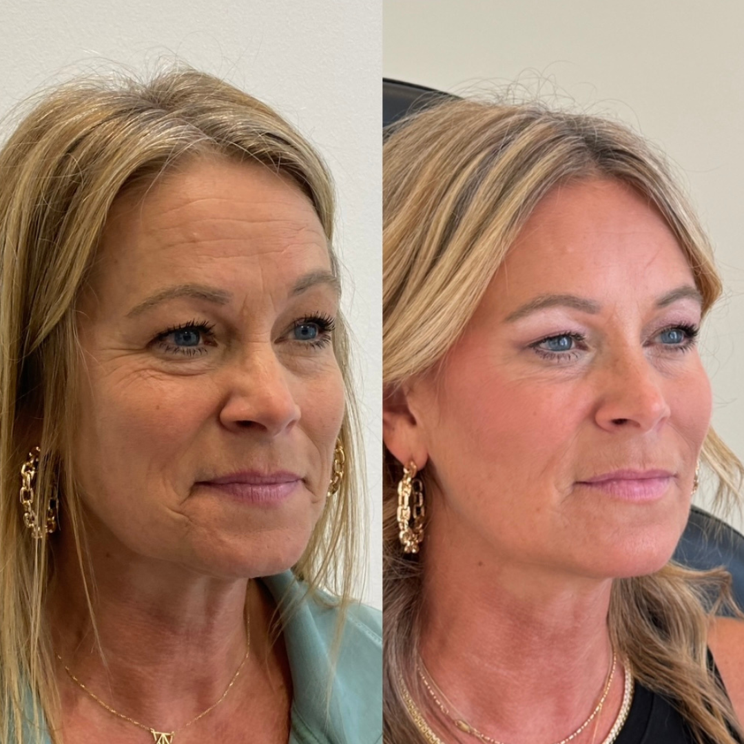 Blueprint patient before and after — Park Aesthetics