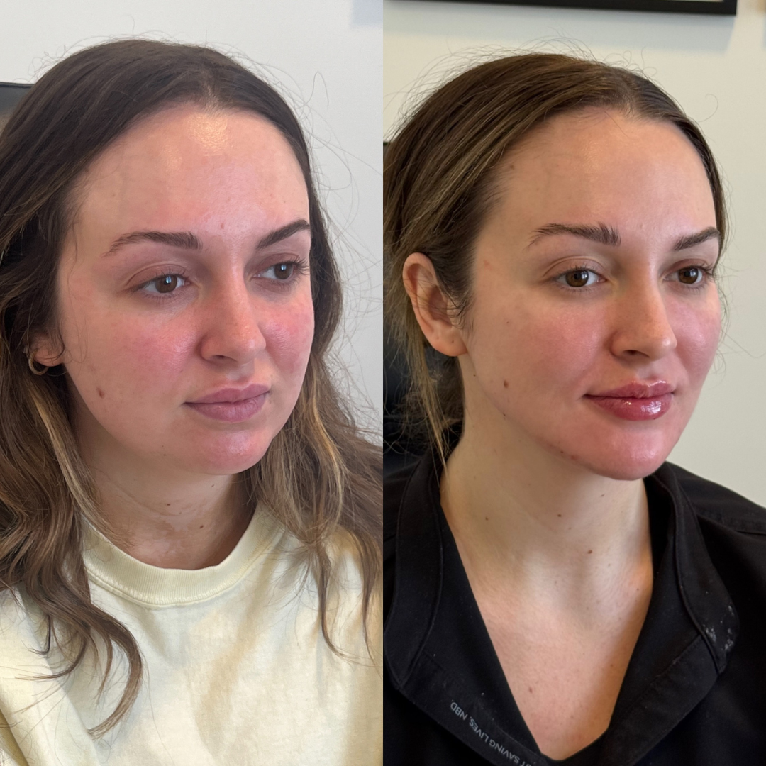 Blueprint patient before and after — Park Aesthetics