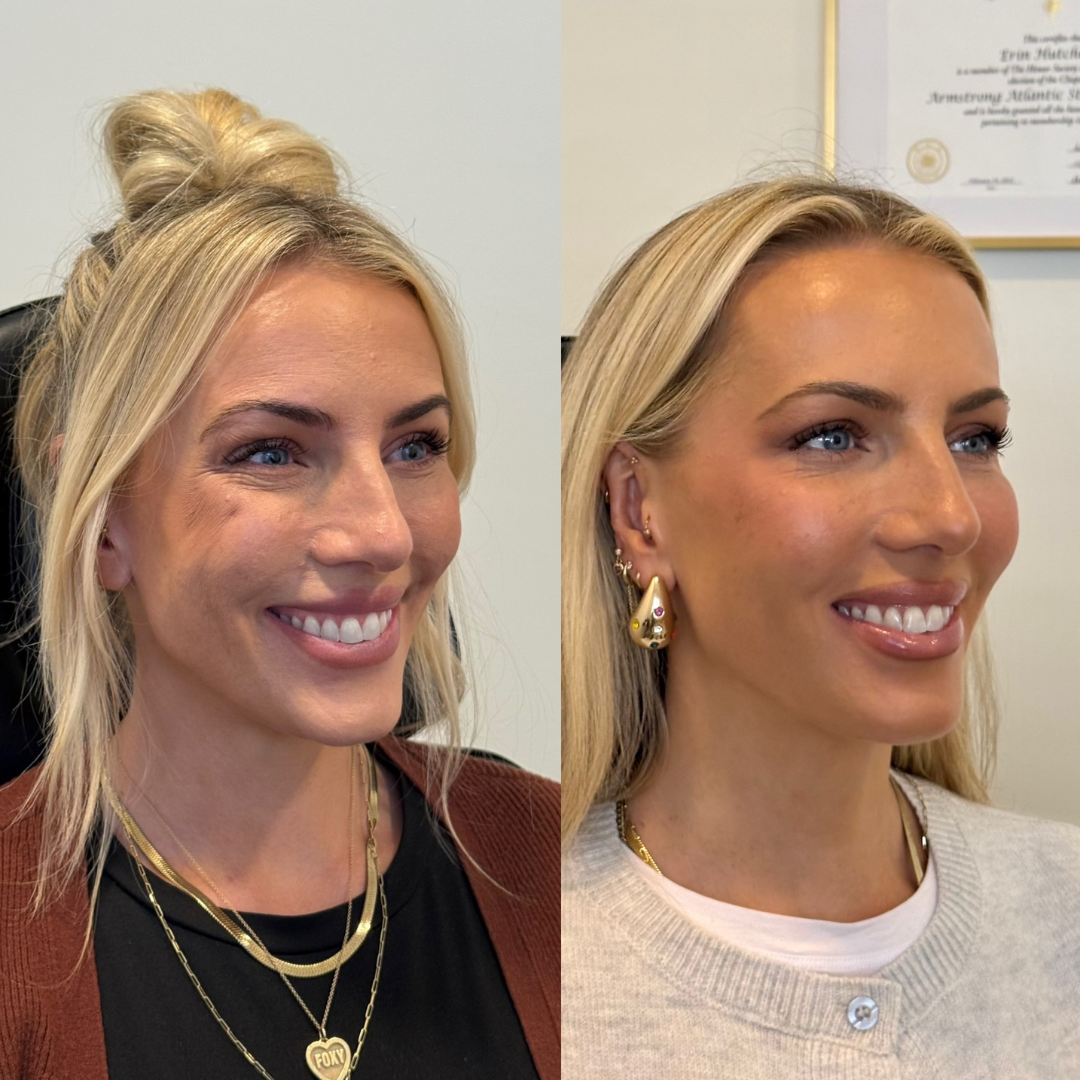 Blueprint patient before and after — Park Aesthetics