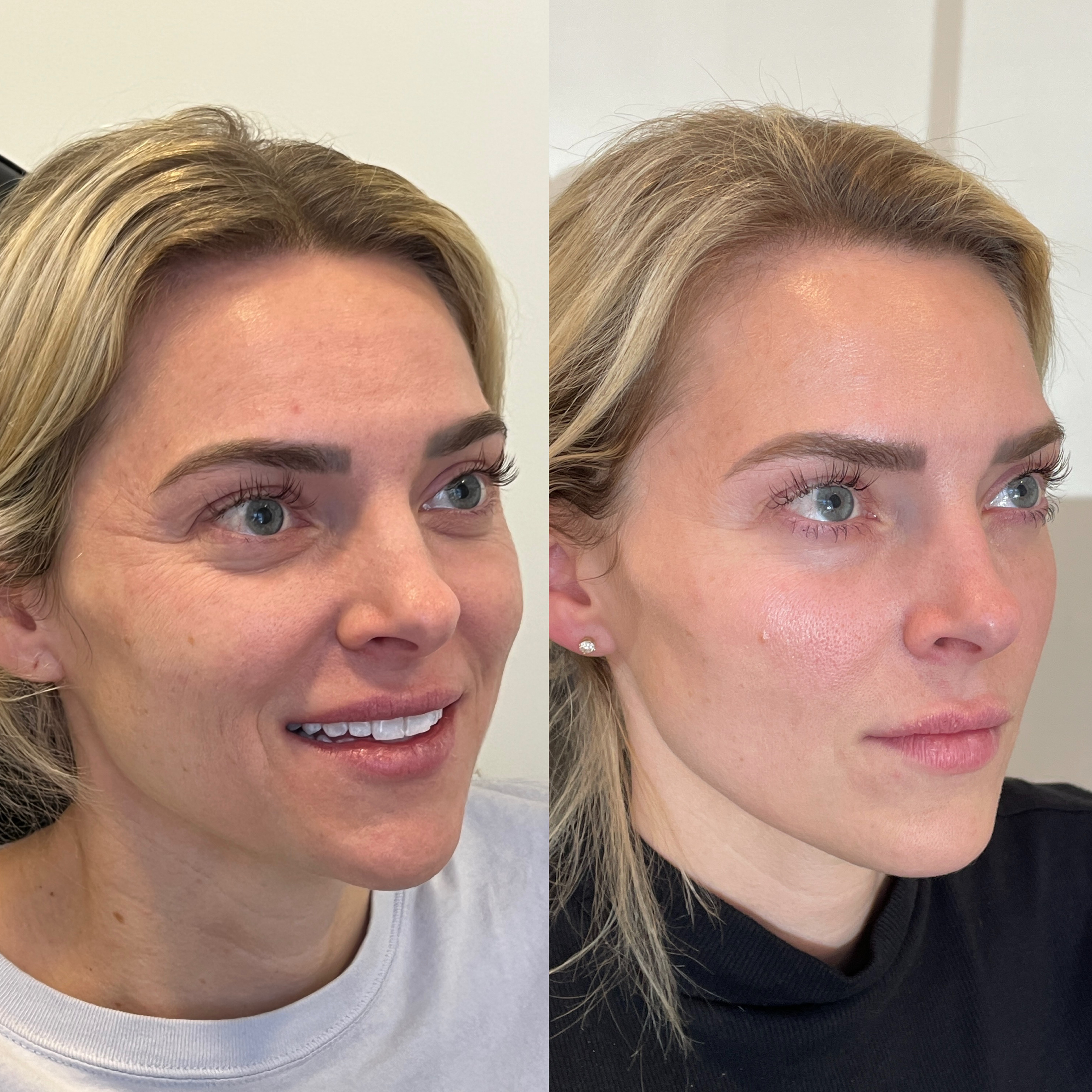 Microneedling before and after — Park Aesthetics