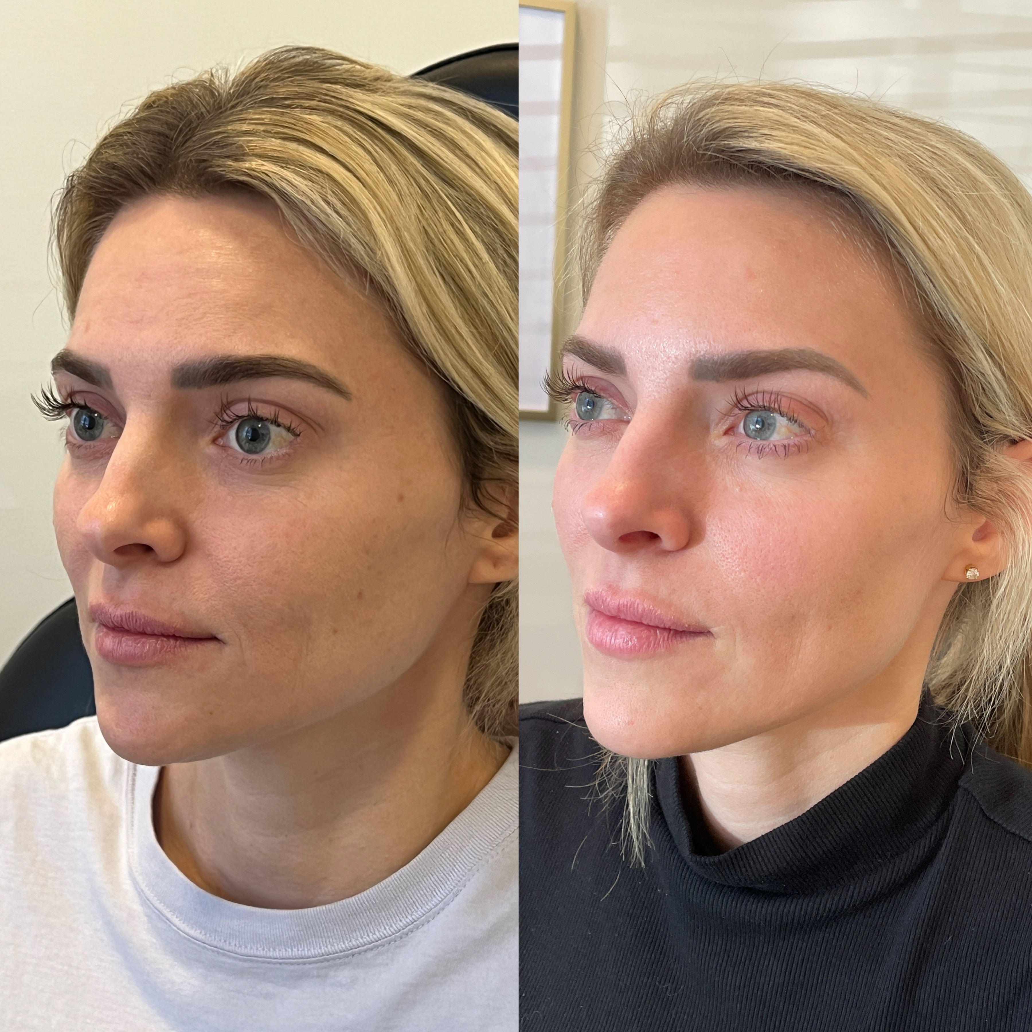 Microneedling before and after — Park Aesthetics