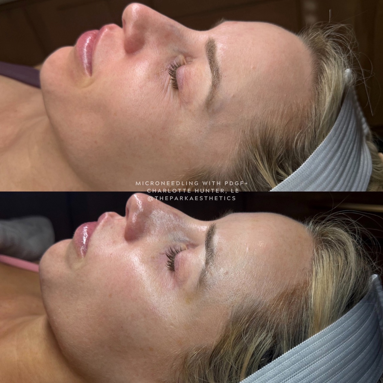 Microneedling before and after — Park Aesthetics