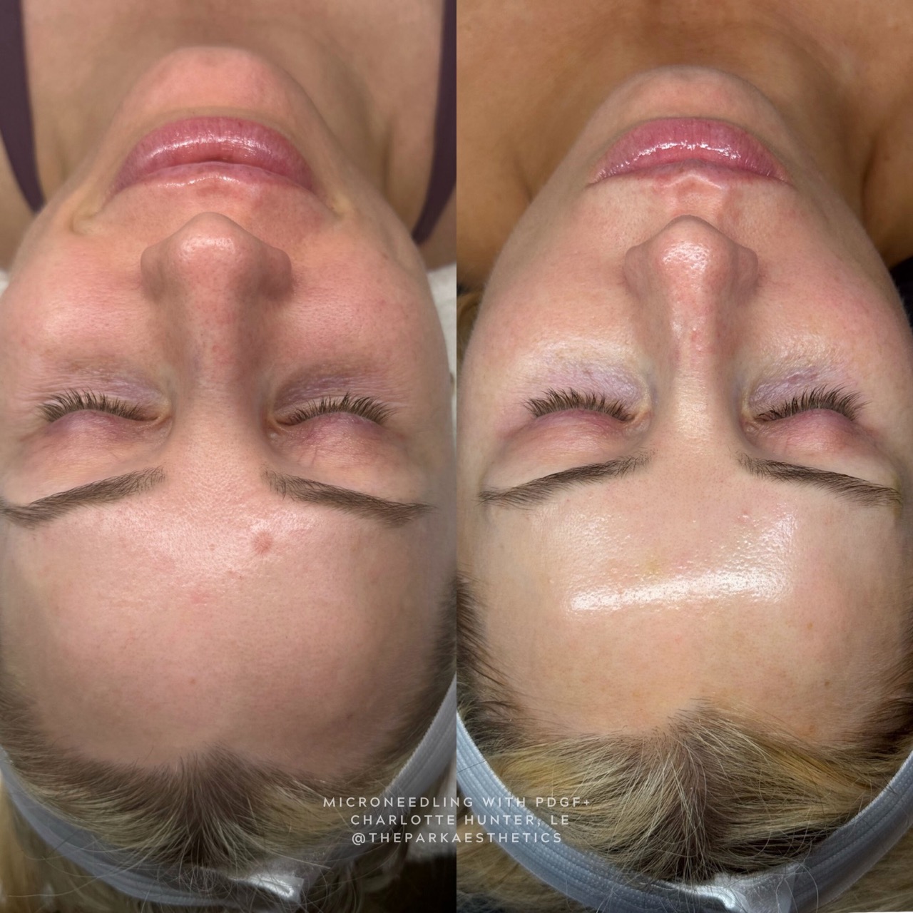 Microneedling before and after — Park Aesthetics