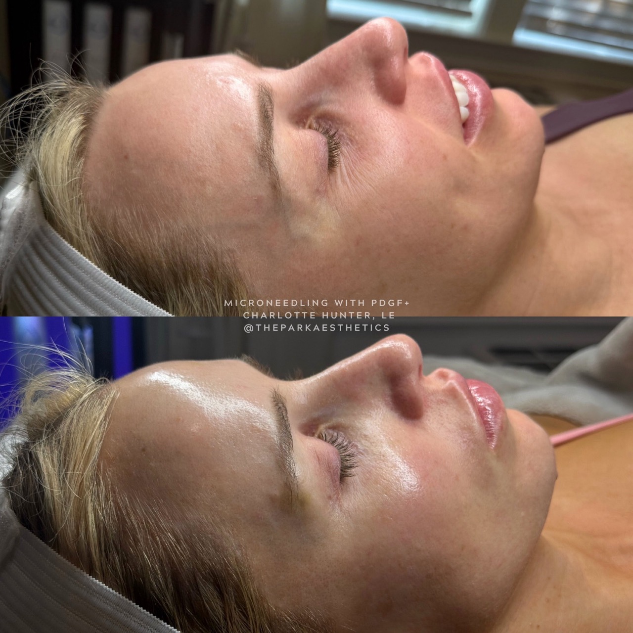 Microneedling with PDGF+ before and after — Park Aesthetics