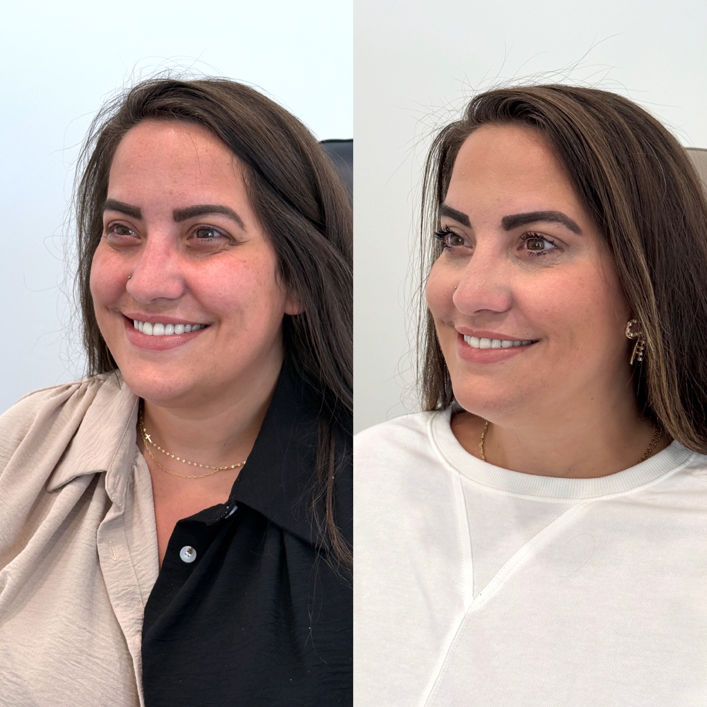 Botox before and after &mdash; Park Aesthetics, Savannah