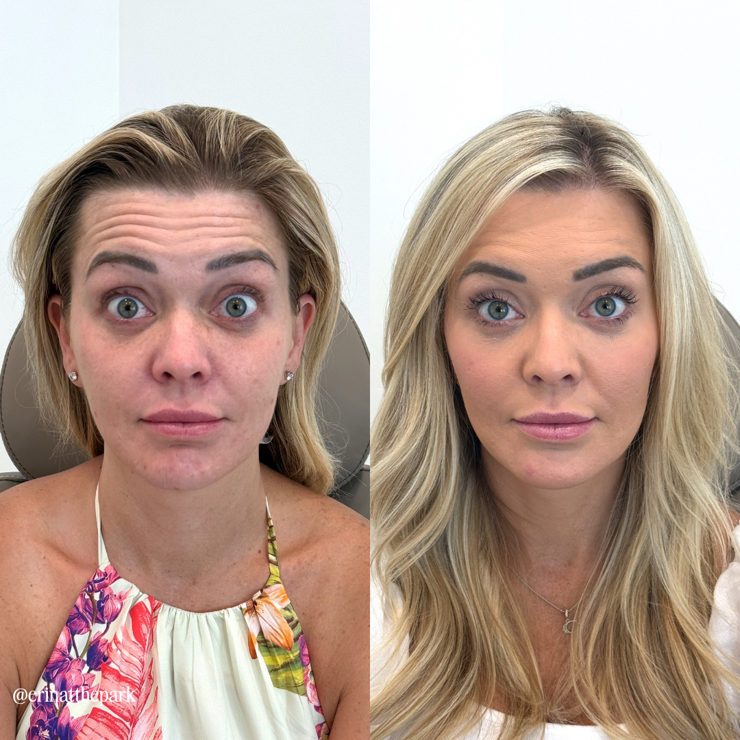 Botox before and after — Park Aesthetics, Savannah