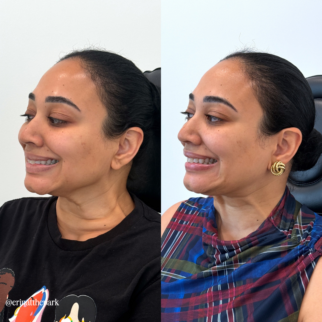 Botox before and after — Park Aesthetics, Savannah