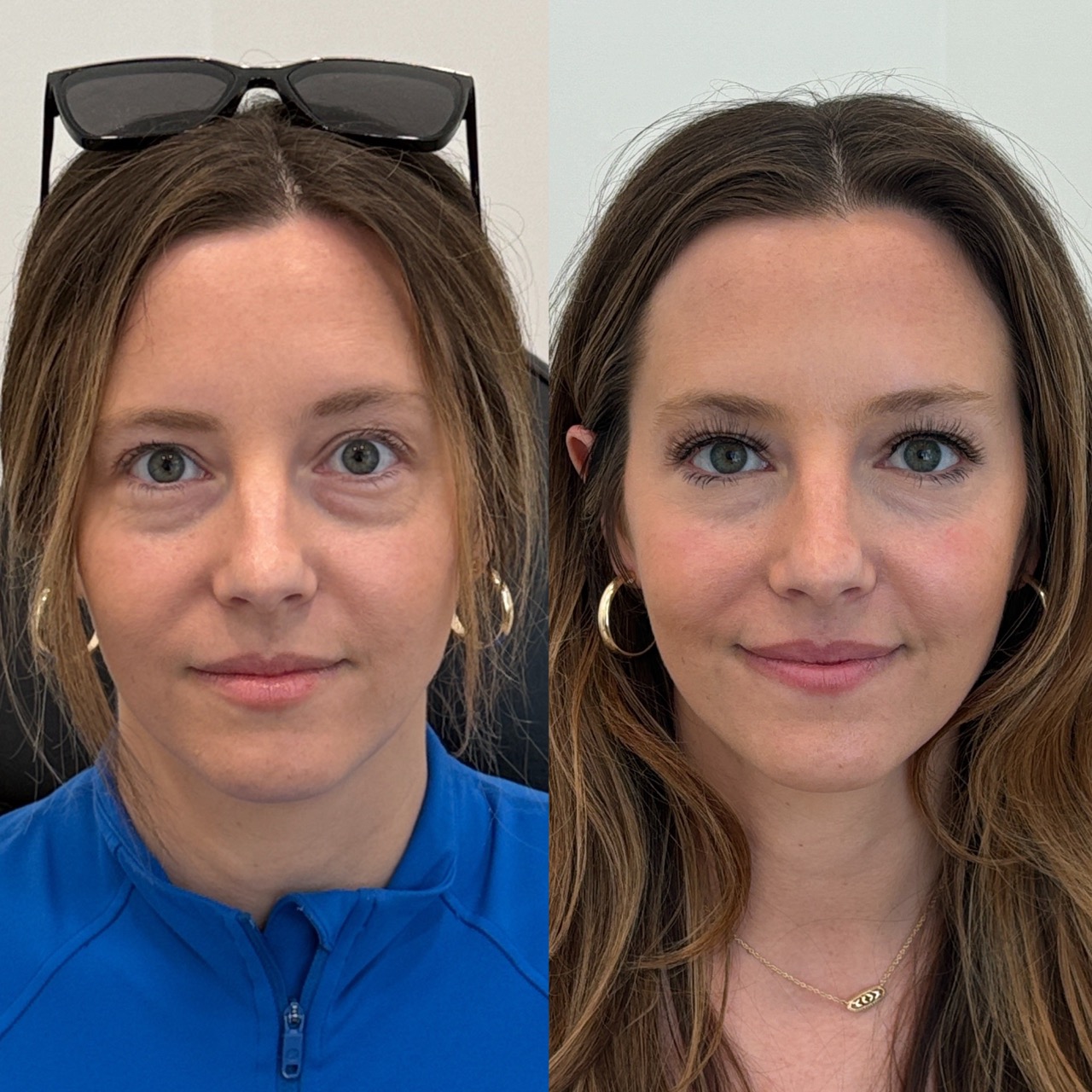 Botox before and after — Park Aesthetics, Savannah