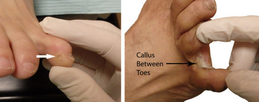 Corns And Calluses Gulf South Foot Ankle Corns And Calluses Gulf South Foot Ankle