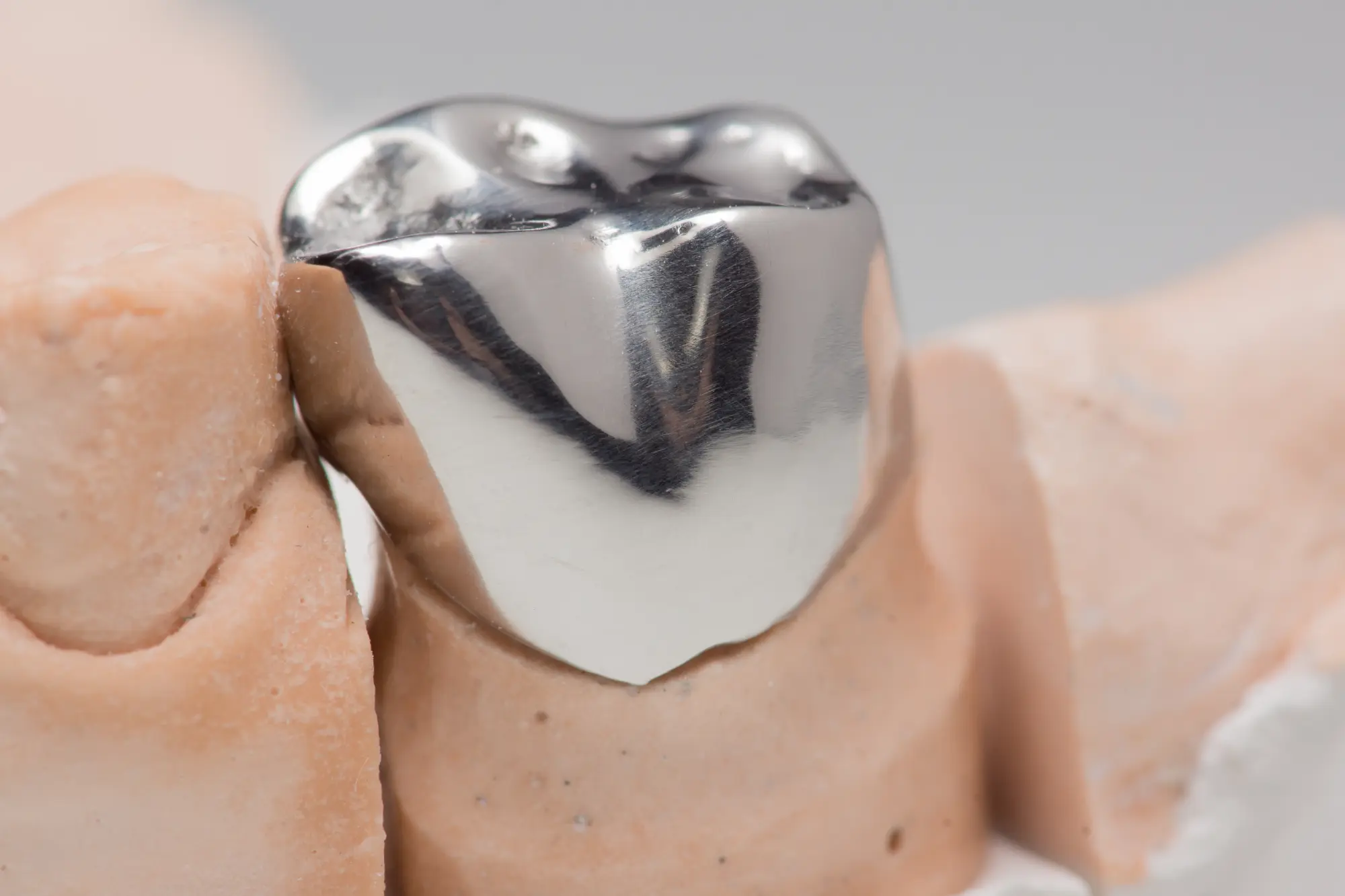 Stainless Steel vs. White Crowns for Kids: What’s the Difference?