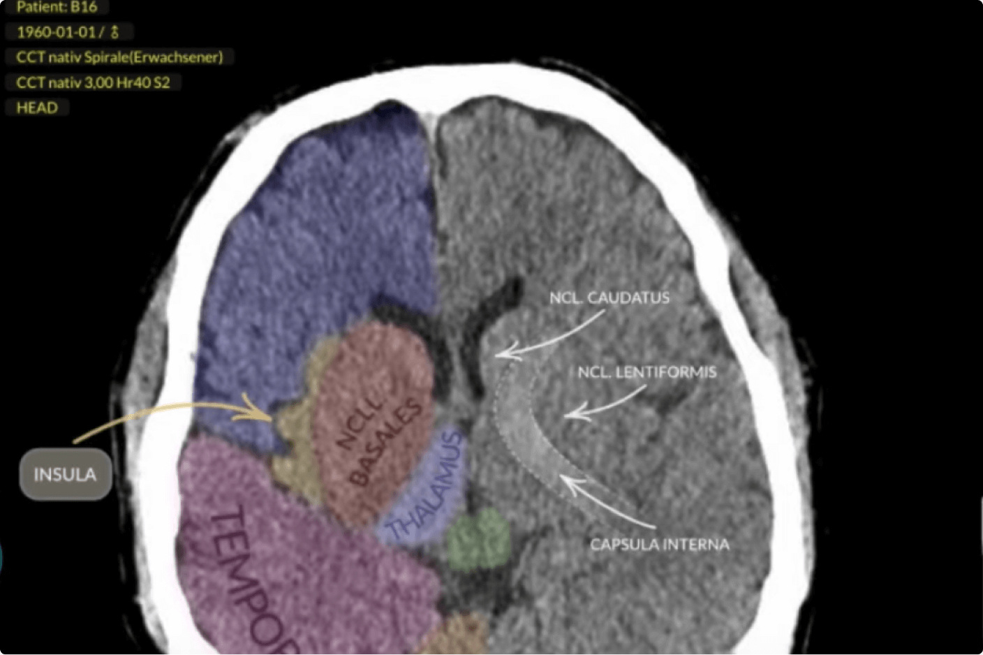CT-Schädel-Schnittbild_Online-Fortbildung_Radiologie kompakt