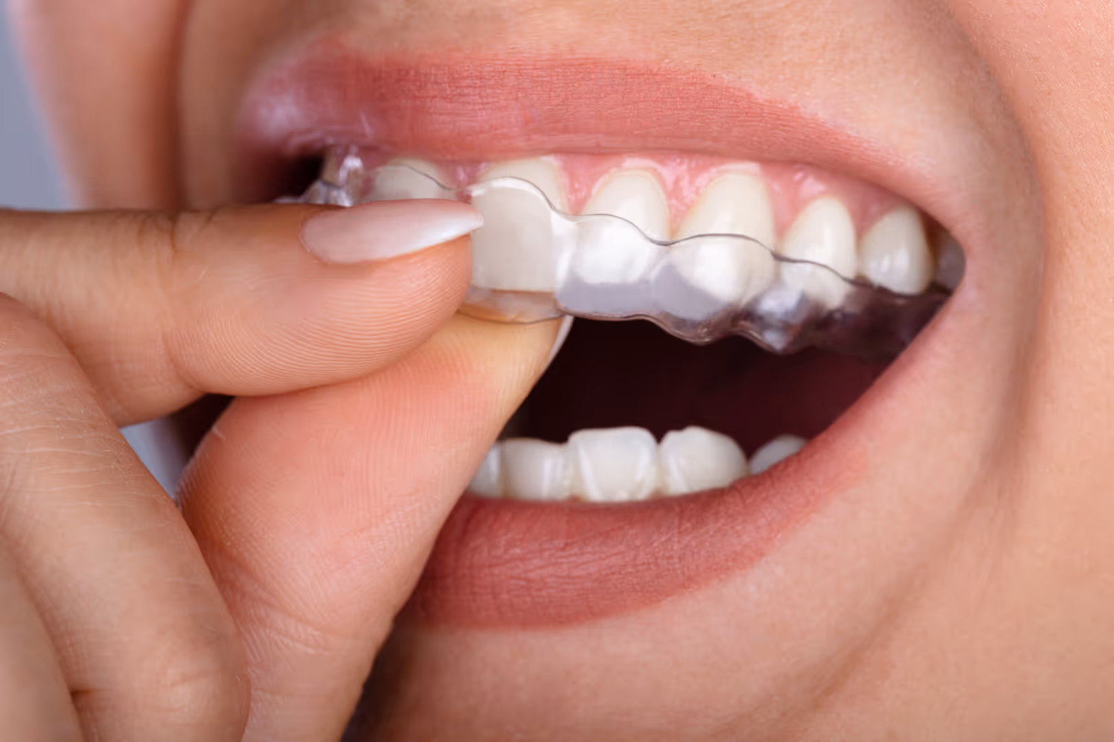 Alineadores transparentes/Invisalign