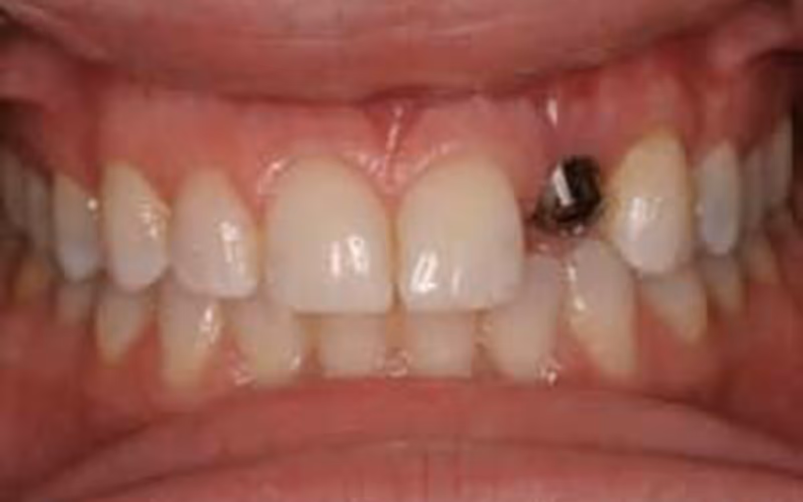 Close-up of upper and lower teeth with dental implant abutment visible where a tooth is missing.